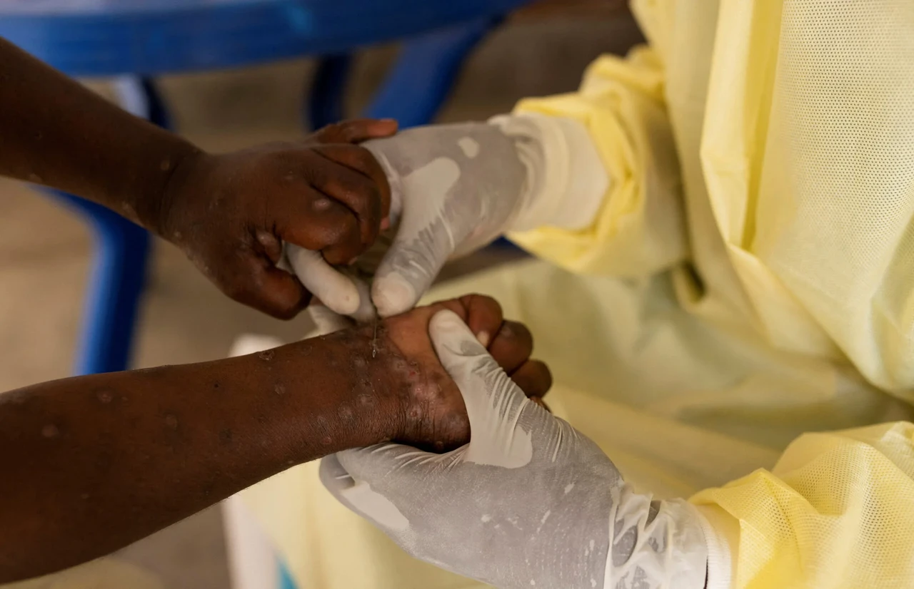 Résurgence de cas du mpox: L’Afrique a besoin de 10 millions de vaccins pour soigner ses malades