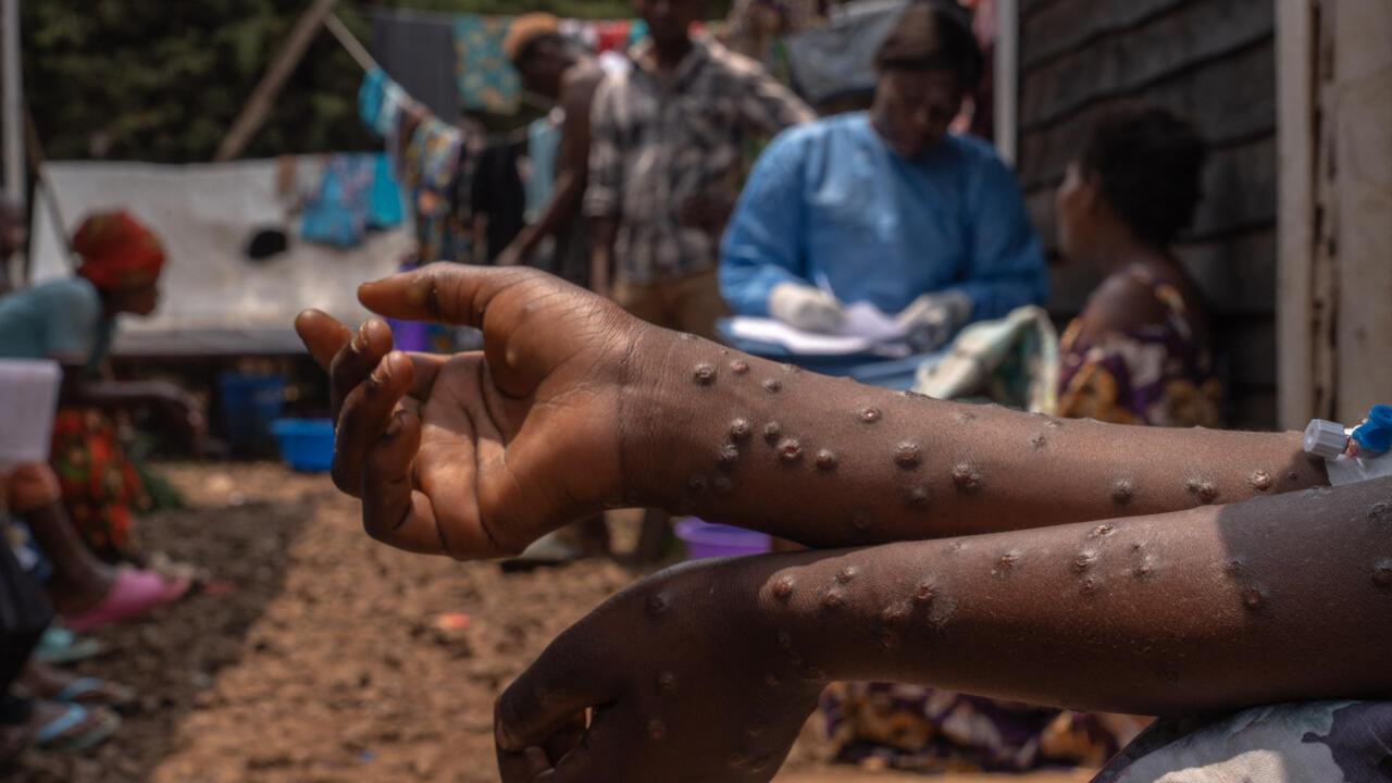 Près de 54.000 cas suspects de Mpox recensés en RDC, depuis le début de cette année